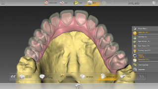 inLab CAD Software, Multi-layer-gingiva