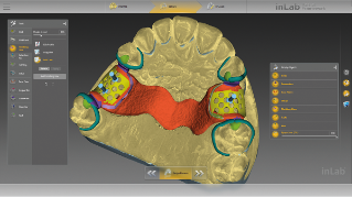 inLab CAD Software, removable partial dentures