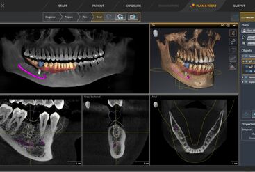 inLab CAD Software, optical scan in combination with 3D X-ray data