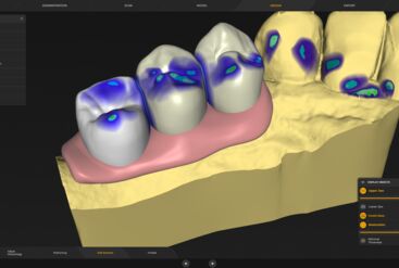 inLab CAD Software, Gingiva element design